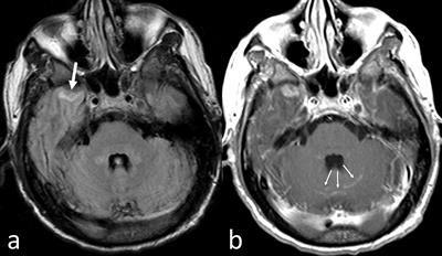 Central Nervous System Myeloma and Unusual Extramedullary Localizations: Real Life Practical Guidance